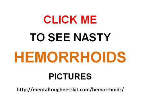  Internal Hemorrhoids