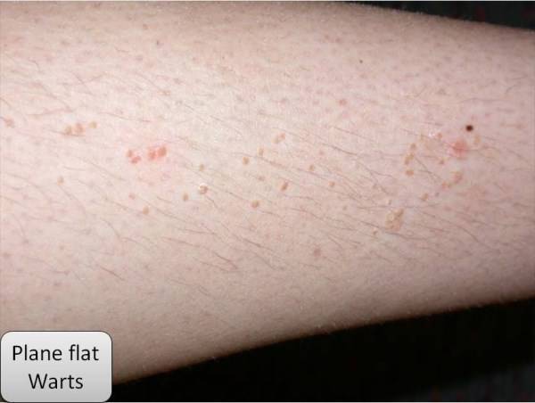 Warts